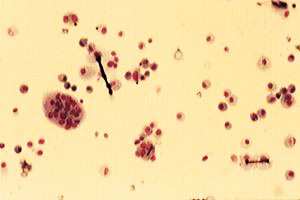 Image showing: Asbestos bodies in bronchoalveolar fluid.