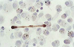 Image showing: Asbestos body surrounded by alveolar macrophages.
