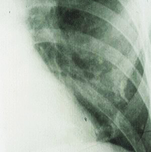 Image showing: Chest radiograph