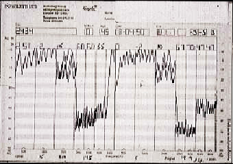 Image showing: An audiogram showing a dip about 4000Hz.
