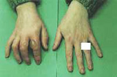 Blistered hands