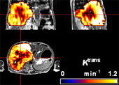 Image: Parameter map of tumour Ktrans - a composite parameter reflecting both blood flow and capillary permeability