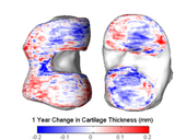Image: Average change in cartilage thickness of a population of 50 patients over 1 year