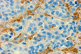 MCT4 staining in human breast cancer