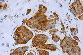 Mitochondrial activity in human breast cancer
