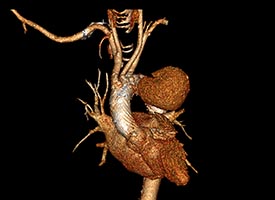 Image: 3D reconstruction of a CT angiogram showing a new multilayer flow modulating stent inserted around the aortic arch from the ascending aorta into the descending aorta