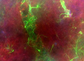 Image of haemorrhagic stroke